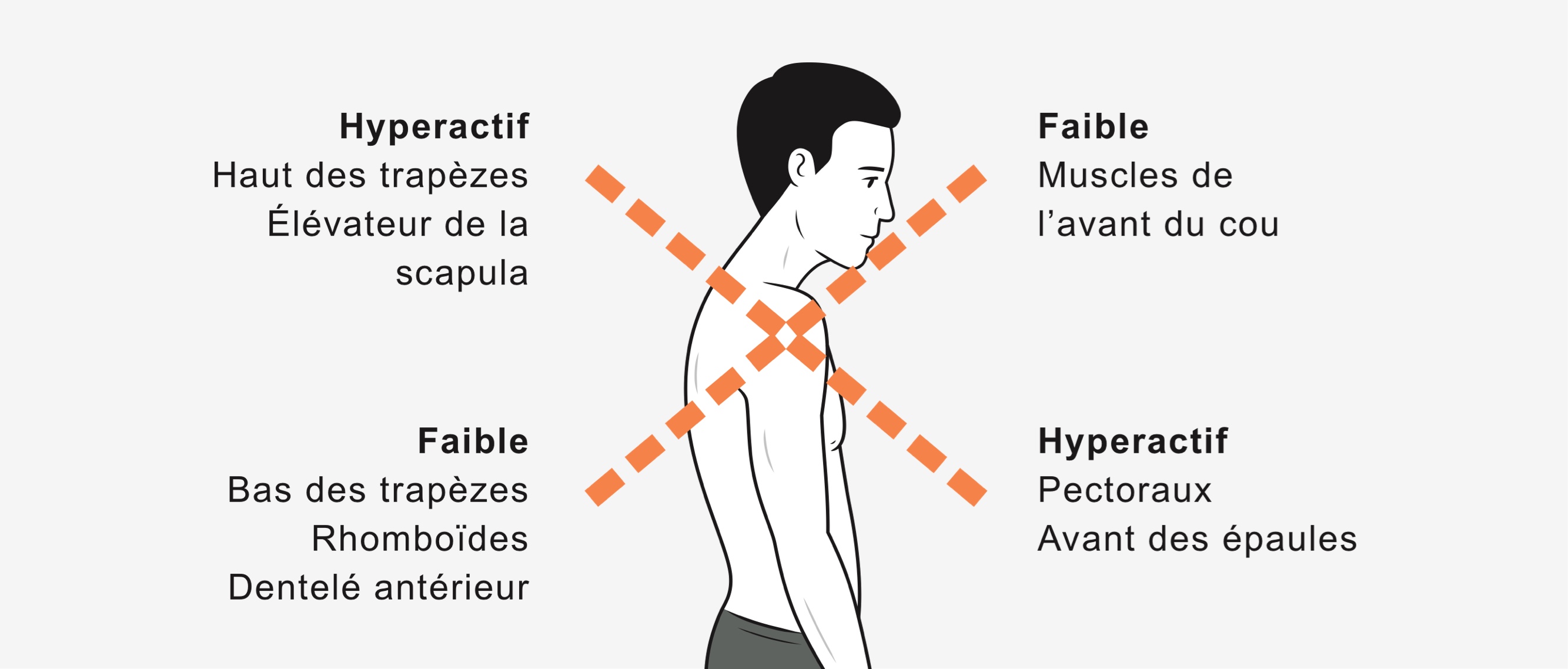 Articles / Les déséquilibres posturaux